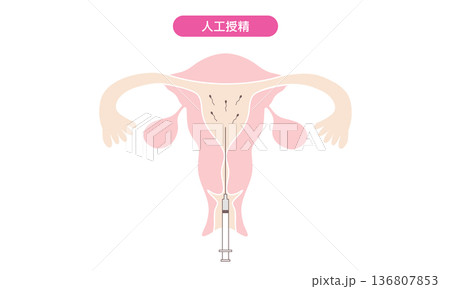 人工授精のイメージイラスト 136807853