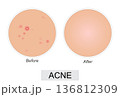 Vector illustration showing acne skin condition before and after treatment. 136812309
