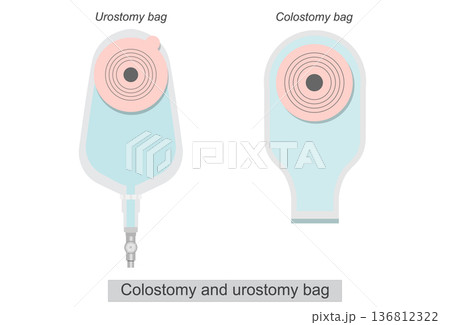 Colostomy and urostomy bag on abdomen isolated on white background. Colostomy and urostomy bag on abdomen isolated on white background. 136812322
