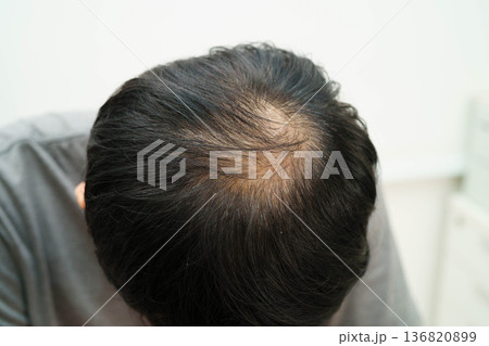 Bald in the middle head and begin no loss hair glabrous of mature man. Bald in the middle head and begin no loss hair glabrous of mature man. 136820899