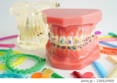 Orthodontic ligatures rings and ties, elastic rubber bands on orthodontic braces, model for dentist studying about dentistry. Orthodontic ligatures rings and ties, elastic rubber bands on orthodontic braces, model for dentist studying about dentistry. 136820900