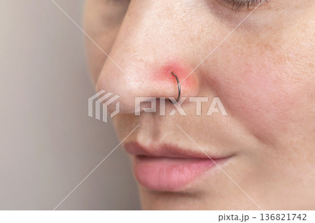 A woman's nose piercing. Inflamed piercing, nose after piercing. Red nose piercing site. Close up photo A woman's nose piercing. Inflamed piercing, nose after piercing. Red nose piercing site. Close up photo 136821742