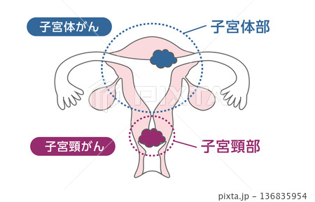 子宮頸がんと子宮体がんの医療イラスト 子宮頸がんと子宮体がんの医療イラスト 136835954