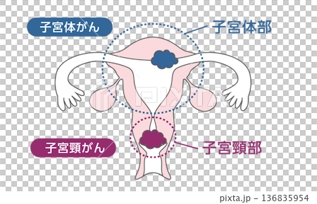 子宮頸癌和子宮內膜癌的醫學插圖 136835954