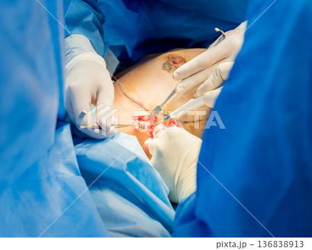 Surgery to remove the breast and replace it with an implant. 136838913