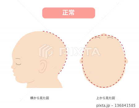 横と真上から見た頭の形が正常な赤ちゃんのイラスト　斜頭症,短頭症,長頭症との比較 136841585