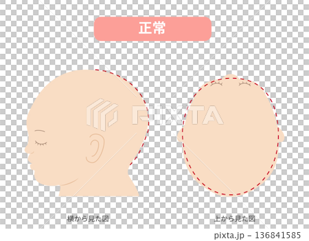 Illustration of a baby with a normal head shape seen from the side and directly above. Comparison with plagiocephaly, brachycephaly, and dolicocephaly. 136841585