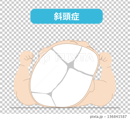 Sleeping posture: The mechanism by which the head shape of a baby is distorted depending on the direction of the head while sleeping, plagiocephaly, brachycephaly, dolicocephaly Sleeping posture: The mechanism by which the head shape of a baby is distorted depending on the direction of the head while sleeping, plagiocephaly, brachycephaly, dolicocephaly 136841587