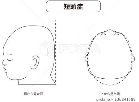 白黒線画　横と真上から見た頭の形に歪みがある斜頭症,短頭症,長頭症の赤ちゃんのイラスト 136841589