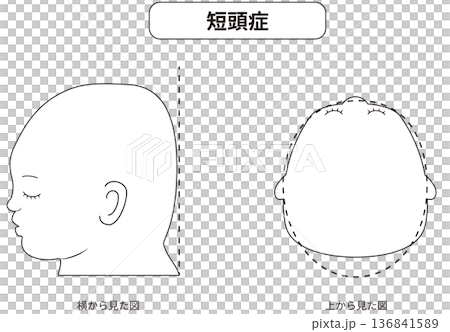 白黒線画　横と真上から見た頭の形に歪みがある斜頭症,短頭症,長頭症の赤ちゃんのイラスト 136841589