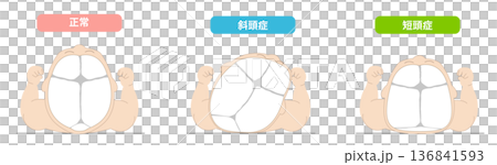 睡眠姿勢：嬰兒頭部形狀因睡眠時頭部位置而扭曲的機制，包括斜頭畸形、短頭畸形和長頭畸形。 136841593