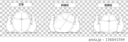 一幅黑白線條畫，描繪了一個熟睡的嬰兒。圖中展示了睡眠時頭部形狀會因頭部方向而扭曲的機制，即斜頭畸形和短頭畸形。 136841594