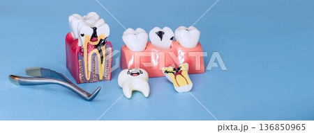 Dental Caries Education Models with Tooth Anatomy Cutaway and Extraction Instrument on Blue Background Dental Caries Education Models with Tooth Anatomy Cutaway and Extraction Instrument on Blue Background 136850965