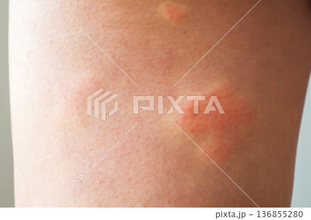 Young asian man has allergic skin rash on his legs from itchy dry skin eczema dermatitis insect bites 136855280