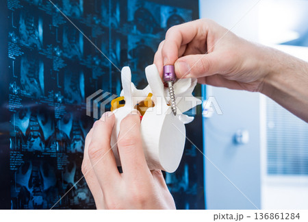 Doctor show polyaxial screw on the spine model. Spine fixation systems 136861284