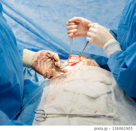 Surgery to remove the breast and replace it with an implant. Surgery to remove the breast and replace it with an implant. 136862903