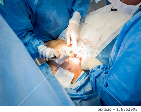 Surgery to remove the breast and replace it with an implant. Surgery to remove the breast and replace it with an implant. 136862908