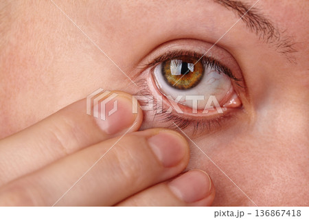 Macro Eye. Woman checking eyeball. Beautiful woman pulls her lower eyelid down to reveal the whites of the eye. Checking for foreign bodies and signs of illness. Optician, Ophthalmology Clinic Macro Eye. Woman checking eyeball. Beautiful woman pulls her lower eyelid down to reveal the whites of the eye. Checking for foreign bodies and signs of illness. Optician, Ophthalmology Clinic 136867418