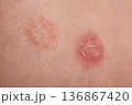 Closeup Inflamed Skin Lesions Showing Scab, Redness, Patient Torso Patch With Surrounding Lighter Discoloration, Moist Crust And Rough Texture, Clinical Dermatology, Epidermal Detail, Derma 136867420