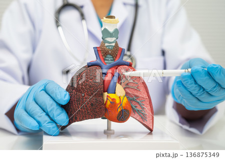 Pneumonia, lung cancer, Asian doctor holding human model. 136875349