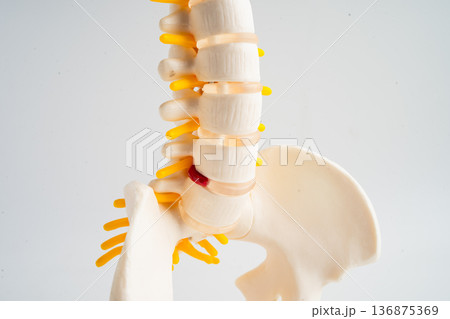 Lumbar spine displaced herniated disc fragment, spinal nerve and bone. Model for treatment medical in the orthopedic department. Lumbar spine displaced herniated disc fragment, spinal nerve and bone. Model for treatment medical in the orthopedic department. 136875369