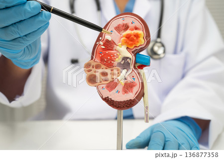 Chronic kidney disease, doctor with model for treatment urinary system, urology, Estimated glomerular filtration rate eGFR. 136877358