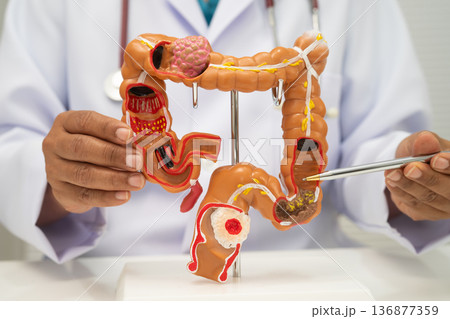 Colorectal cancer, doctor holding intestine colon human anatomy model. Colorectal cancer, doctor holding intestine colon human anatomy model. 136877359