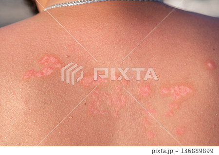 Psoriasis Patches on Skin During Sunny Day Outdoors, Highlighting Skin Condition on Back of Individual at Public Location Psoriasis Patches on Skin During Sunny Day Outdoors, Highlighting Skin Condition on Back of Individual at Public Location 136889899