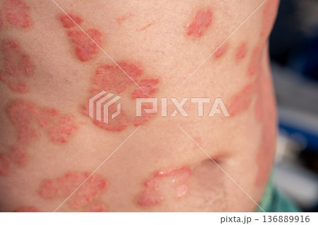 Understanding Psoriasis Through Close-Up View of Skin Lesions on a Persons Back in Clinical Setting Understanding Psoriasis Through Close-Up View of Skin Lesions on a Persons Back in Clinical Setting 136889916