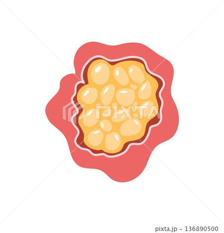 Cancerous tumor, cancer cell growth. cancer disease concept Cancerous tumor, cancer cell growth. cancer disease concept 136890500