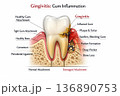 Understanding Gum Inflammation and Its Effects on Dental Health With Clear Illustrations of Affected Areas and Healthy Structures 136890753