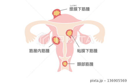 子宮筋腫の種類図解（筋層内筋腫・粘膜下筋腫・漿膜下筋腫・頚部筋腫） 136905569
