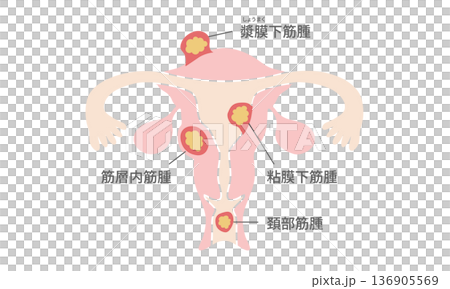 Illustrated guide to types of uterine fibroids (intramural fibroids, submucosal fibroids, subserosal fibroids, cervical fibroids) 136905569