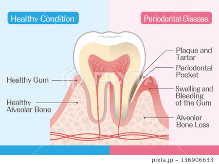 歯周病の仕組みと健康な歯の比較イラスト 136906633