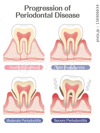 歯周病の進行段階イラスト（軽度・中度・重度） 136906634