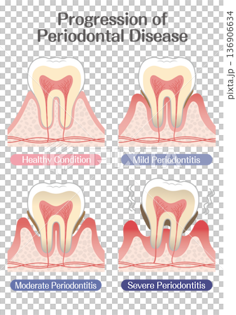 歯周病の進行段階イラスト（軽度・中度・重度） 136906634