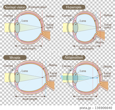 目の構造と屈折異常（正常・近視・遠視・乱視）の説明図 136906640