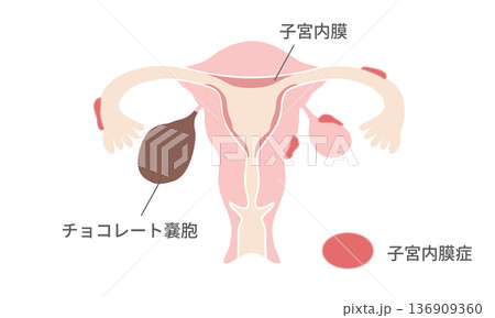 子宮内膜症とチョコレート嚢胞の図解 – 発生部位と構造の違い 子宮内膜症とチョコレート嚢胞の図解 – 発生部位と構造の違い 136909360