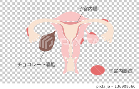 子宮内膜症とチョコレート嚢胞の図解 – 発生部位と構造の違い 子宮内膜症とチョコレート嚢胞の図解 – 発生部位と構造の違い 136909360