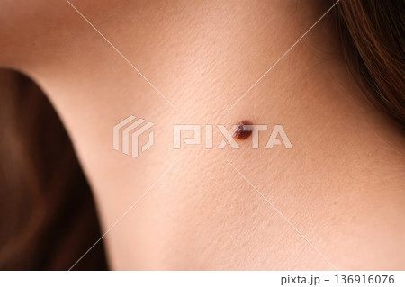 Close up of skin mole on human body dermatology and health concept 136916076