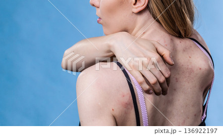 Woman with skin problem acne on back 136922197