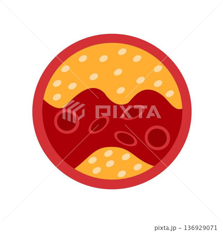 artery clogged with cholesterol artery clogged with cholesterol 136929071