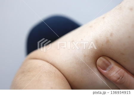 腕の色素沈着。茶色い斑点のクローズアップ。 136934915