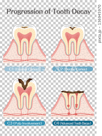 Illustration of tooth decay progression stages C1 to C4 Illustration of tooth decay progression stages C1 to C4 136945970