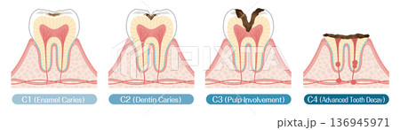 虫歯の進行段階イラスト C1〜C4 解説図 136945971