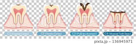 齲齒發展階段 C1 至 C4 的示意圖 136945971