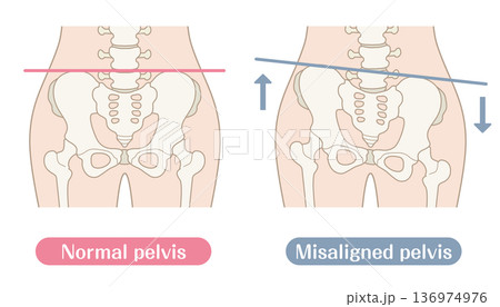 正常な骨盤と歪んだ骨盤の比較イラスト｜カラー 136974976
