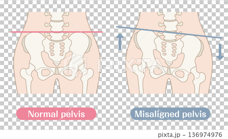 正常な骨盤と歪んだ骨盤の比較イラスト｜カラー 136974976