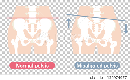 Comparison illustration of normal and distorted pelvis | Color 136974977