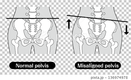 Comparison illustration of normal and distorted pelvis | Monochrome Comparison illustration of normal and distorted pelvis | Monochrome 136974978